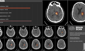 Polski start-up zwiększy skuteczność tomografii komputerowej mózgu